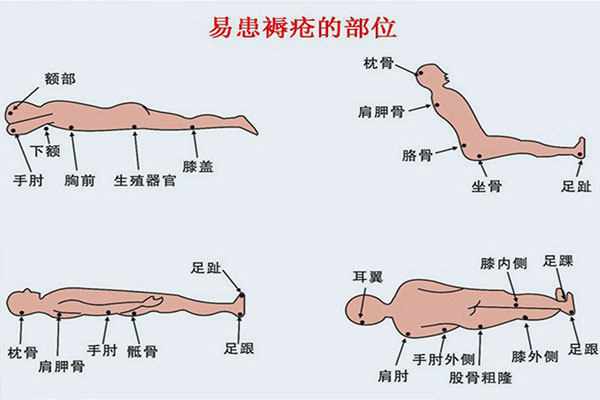 家庭必備護理常識丨冬季褥瘡高發(fā)，長(cháng)期臥床老人如何預防褥瘡？